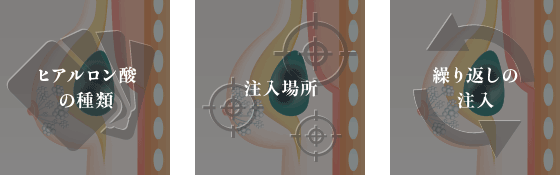 その他、ヒアルロン酸の種類や注入場所、繰り返しの注入なども原因として考えられます。 イメージ