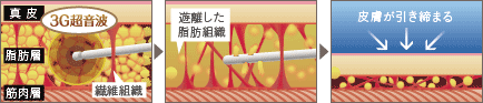 ベイザーリポ イメージ