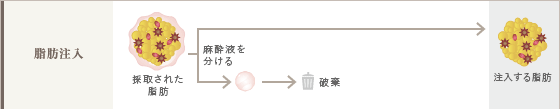 脂肪注入