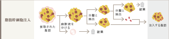 脂肪幹細胞注入