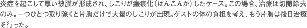 炎症を起こして厚い被膜が形成され、しこりが瘢痕化（はんこんか）したケース。この場合、治療は切開除去のみ。一つひとつ取り除くと片胸だけで大量のしこりが出現。ゲストの体の負担を考え、もう片胸は後日治療を行った。