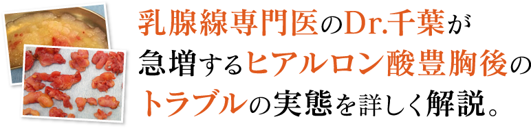 「ヒアルロン酸豊胸しこりの実態」はこちら  。