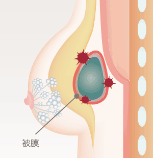 拒絶反応が強く出た場合