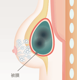 大き過ぎる塊で注入した場合