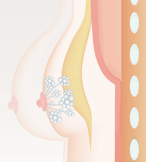 分解後、吸収されてなくなる