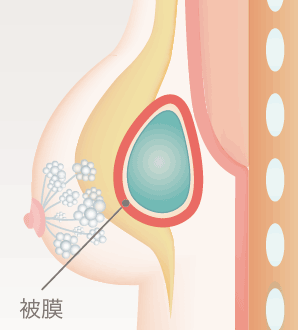 ヒアルロン酸の周囲に被膜を形成