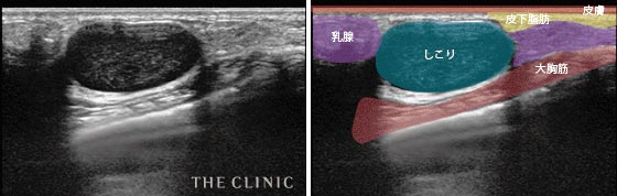 しこりの大きさ