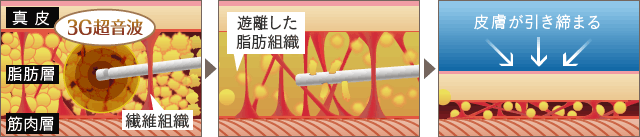 ベイザーリポ