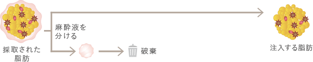 脂肪注入